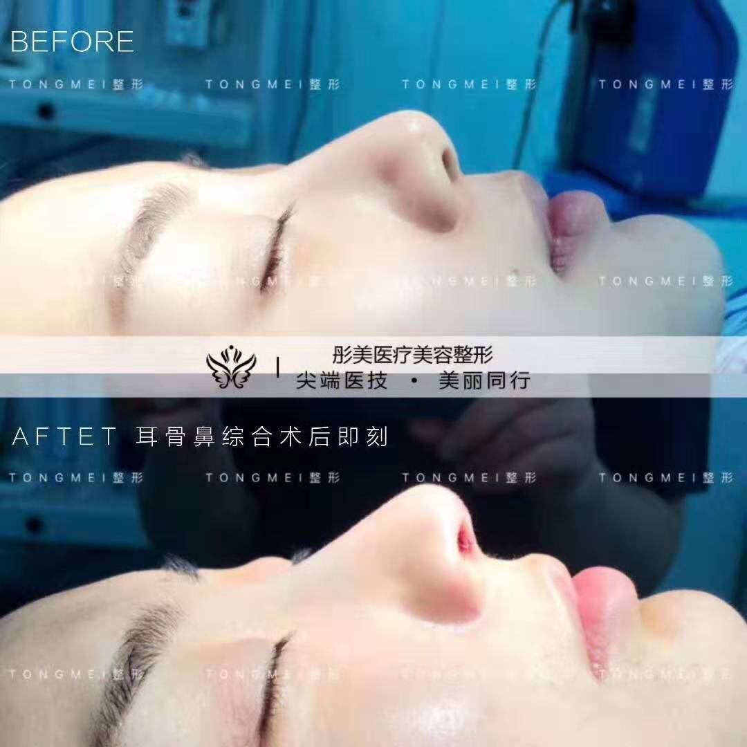 李長賦隆鼻案例