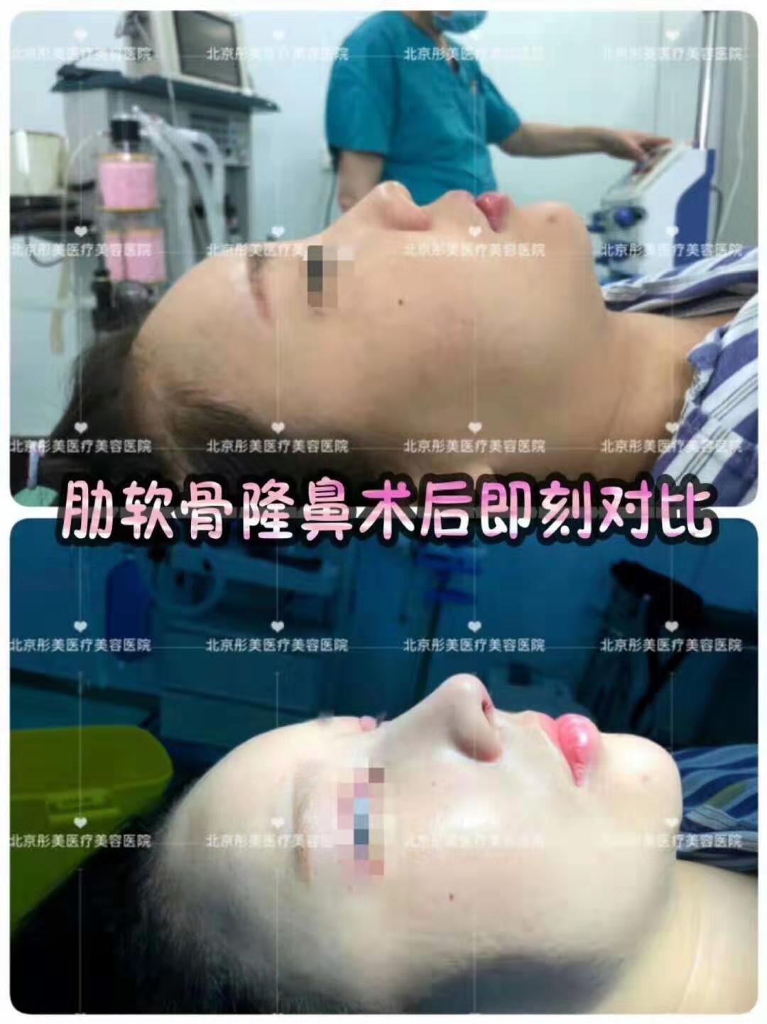 李長賦隆鼻案例