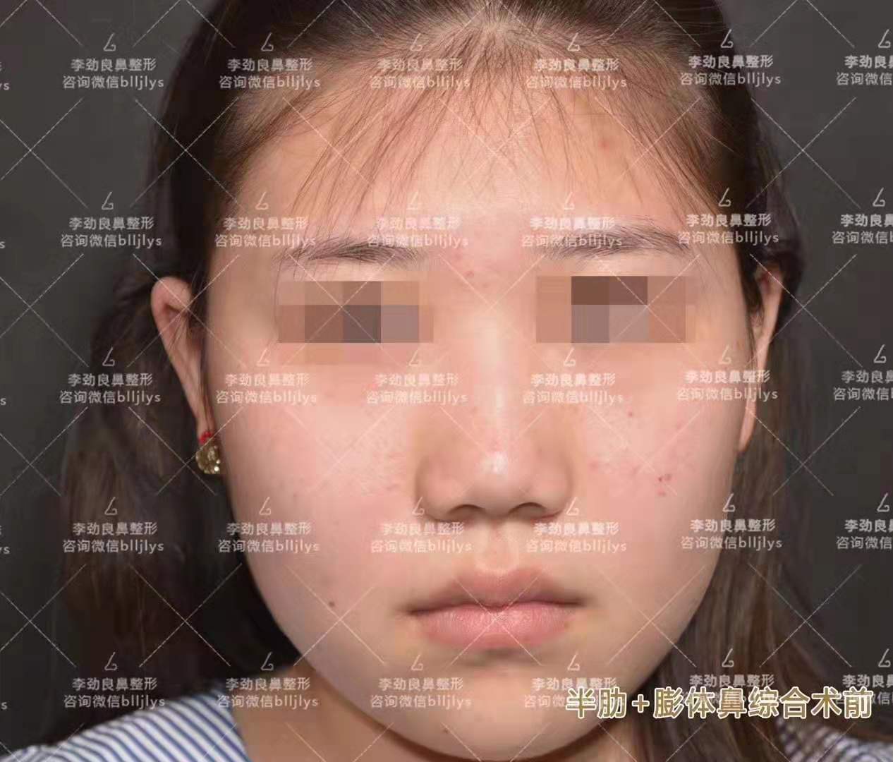 李勁良隆鼻案例
