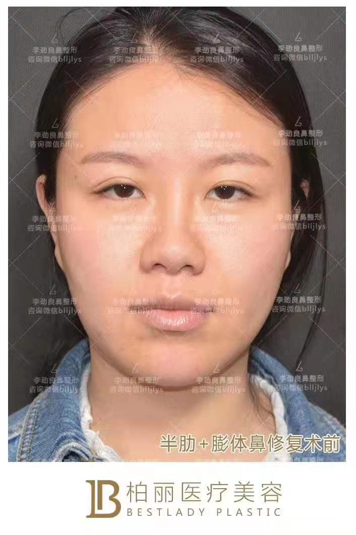 李勁良隆鼻案例
