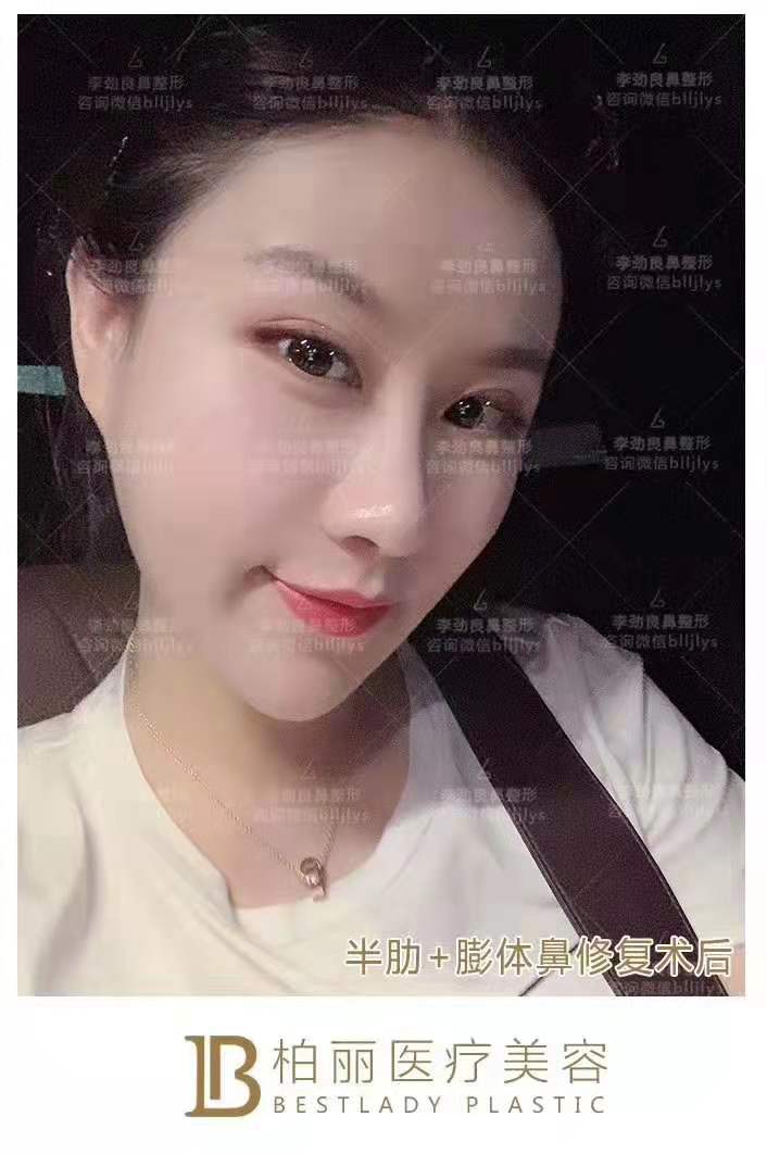 李勁良隆鼻案例
