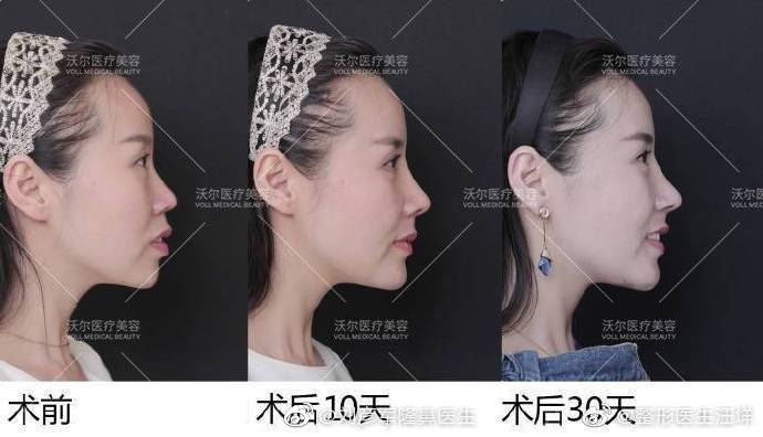 劉彥軍隆鼻案例