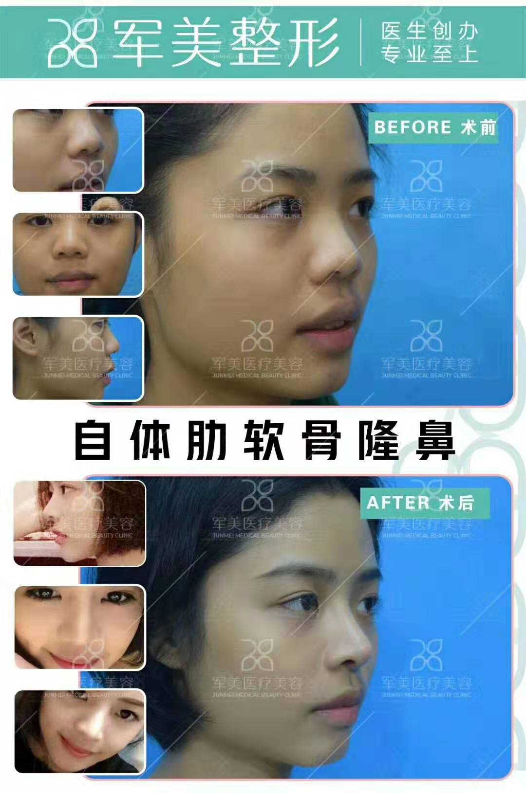 陳國成肋軟骨隆鼻案例