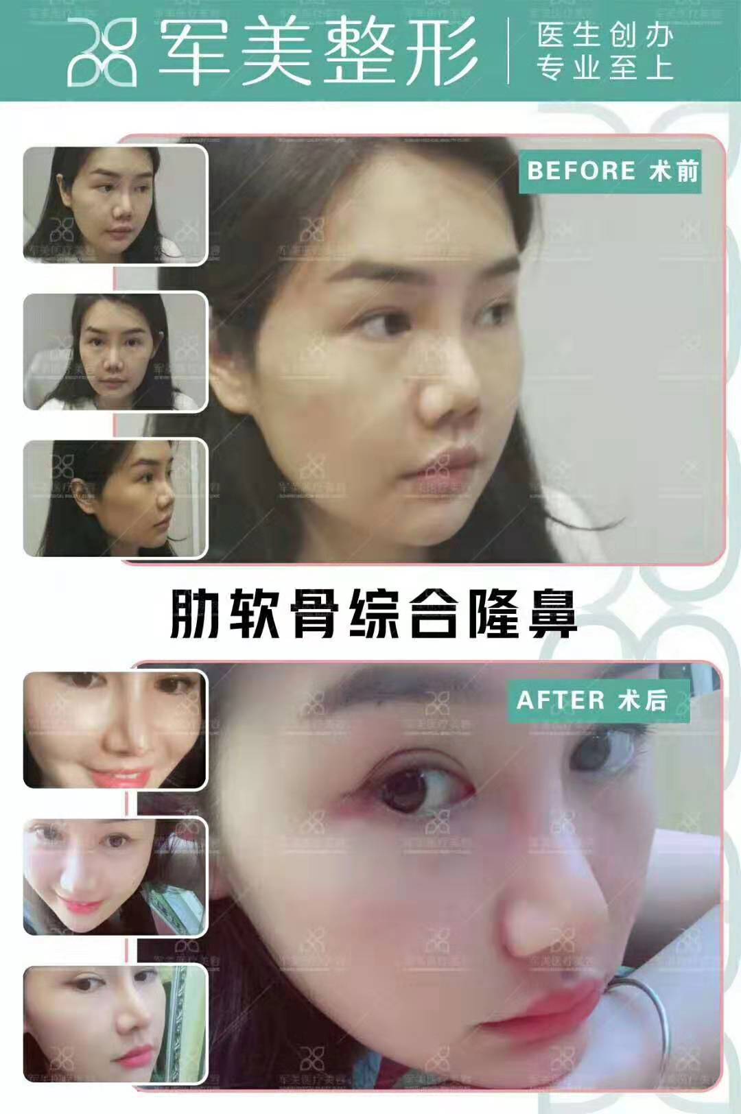 陳國成肋軟骨隆鼻案例