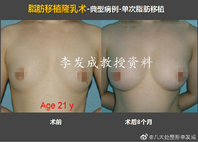 李發(fā)成自體脂肪豐胸案例