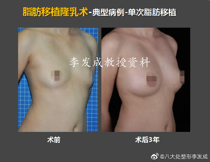 李發(fā)成自體脂肪豐胸案例