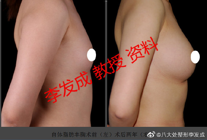 李發(fā)成自體脂肪豐胸