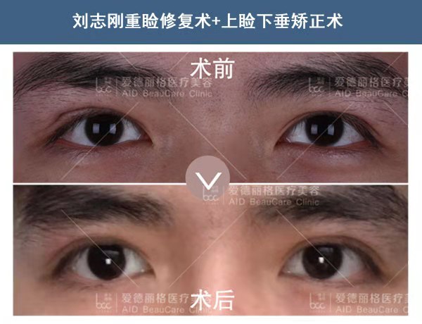 劉志剛雙眼皮修復案例