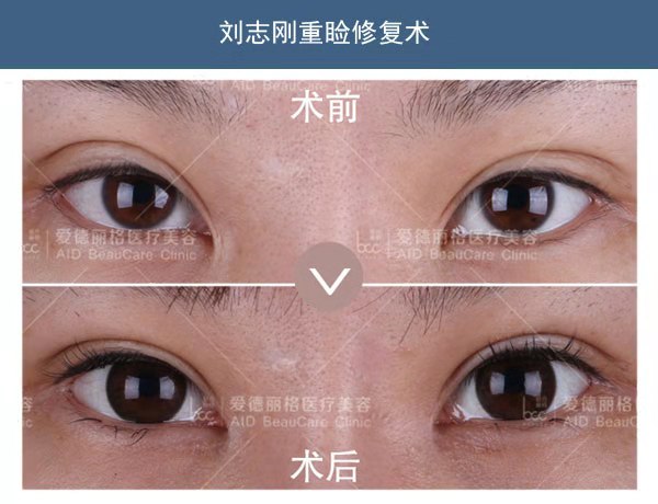 劉志剛雙眼皮修復案例