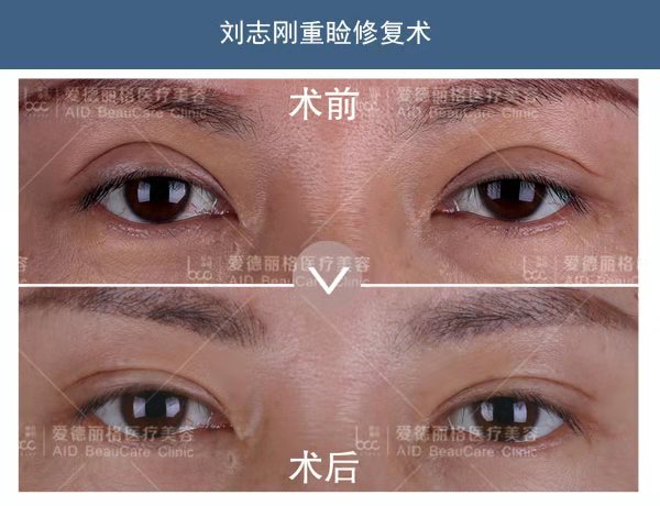 劉志剛雙眼皮修復案例