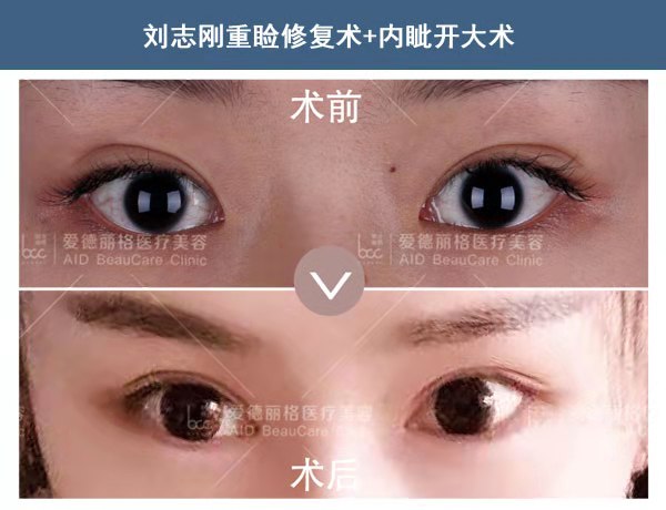 劉志剛雙眼皮修復案例