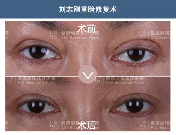 劉志剛雙眼皮修復案例