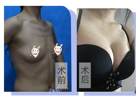 王世虎豐胸案例