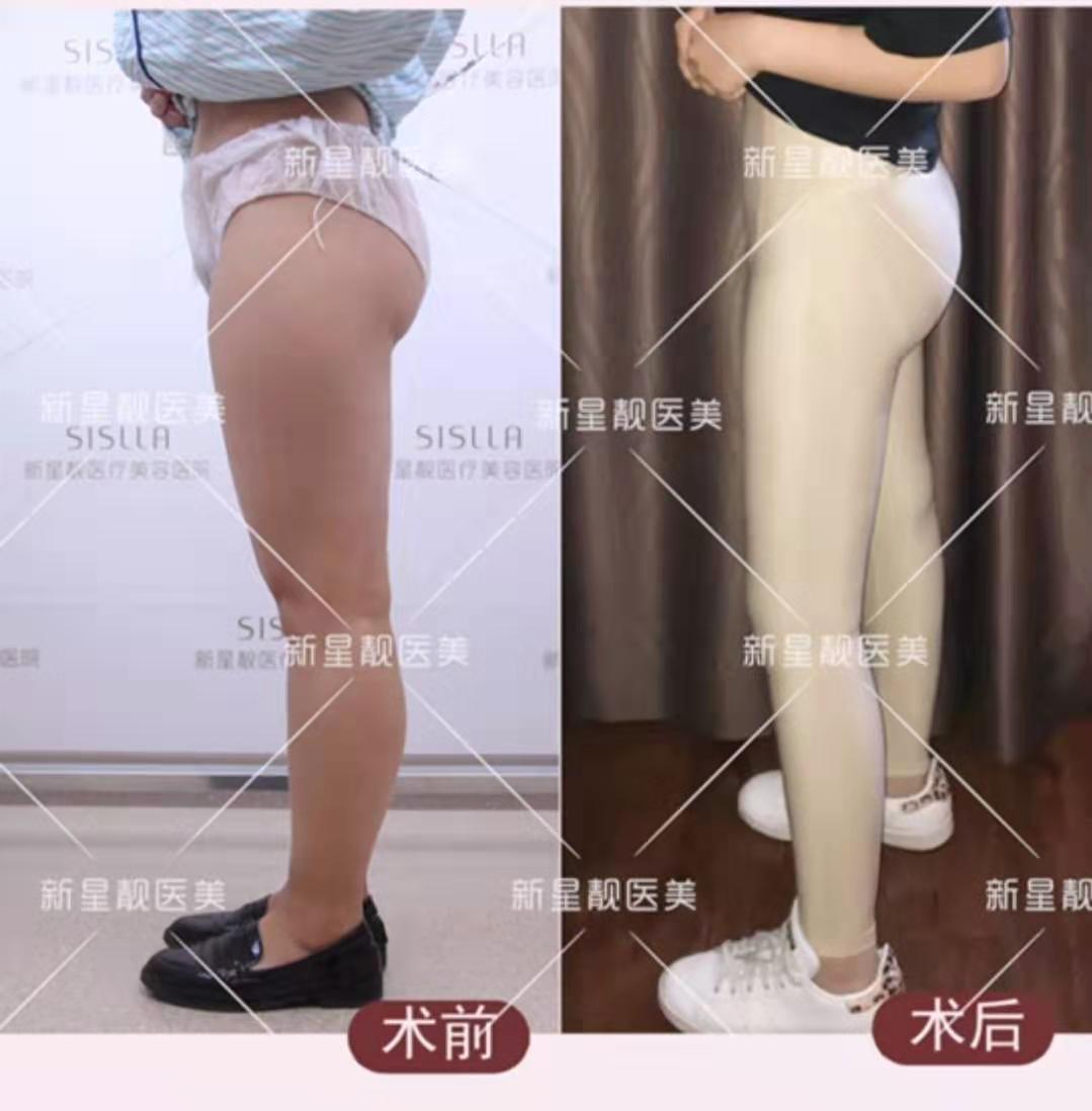 張立彬大腿吸脂