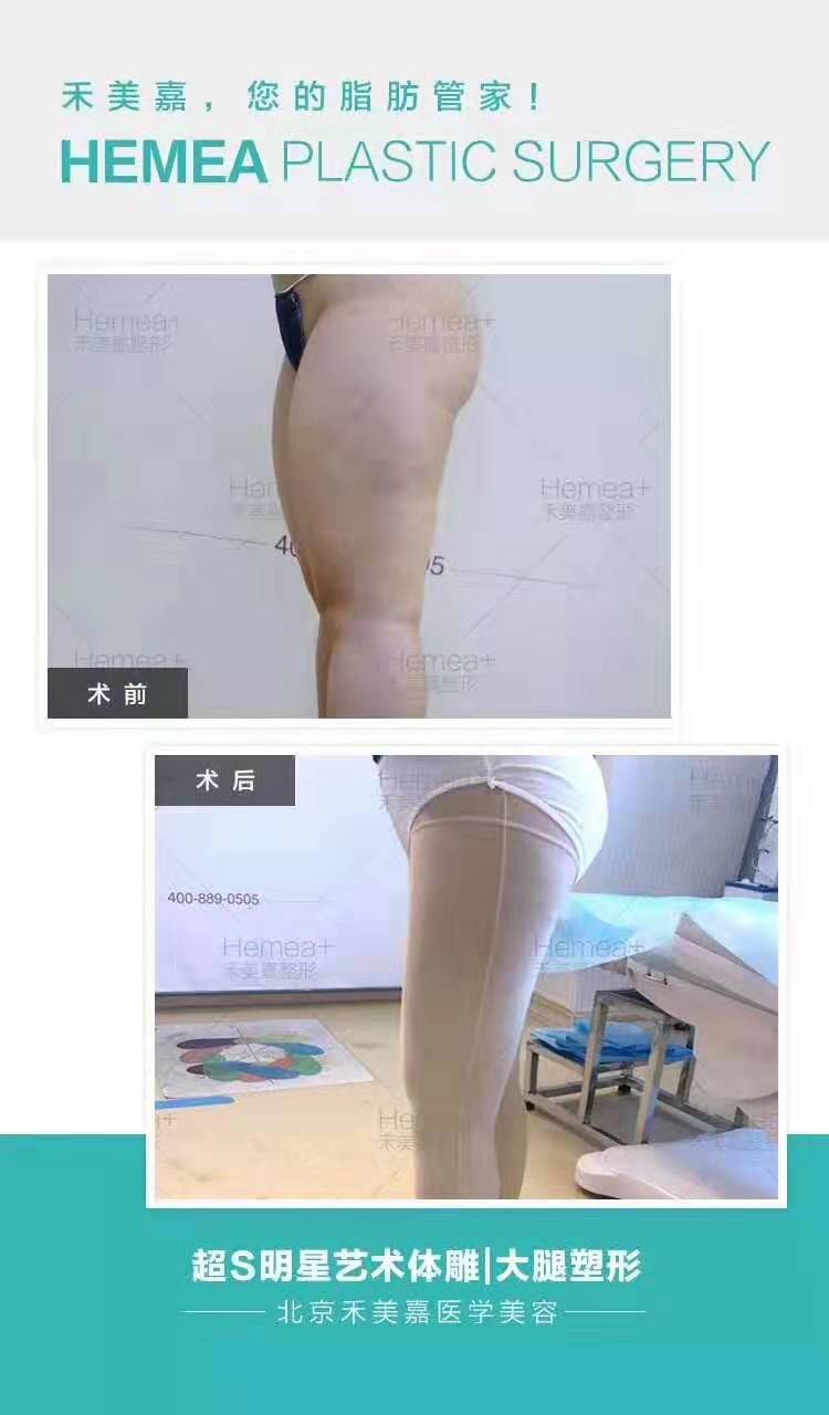 任學會大腿吸脂案例