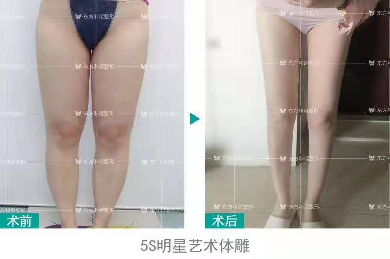 張準大腿吸脂案例