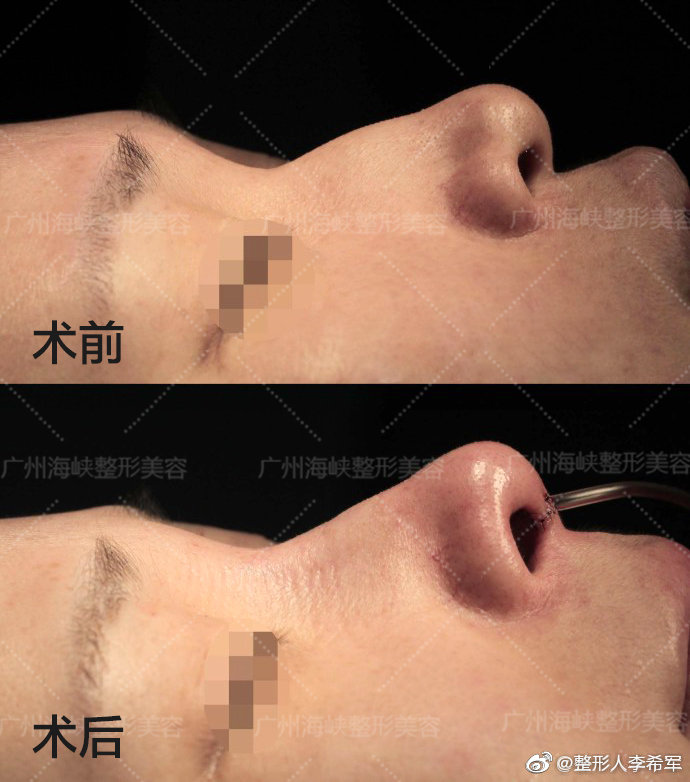 李希軍隆鼻案例