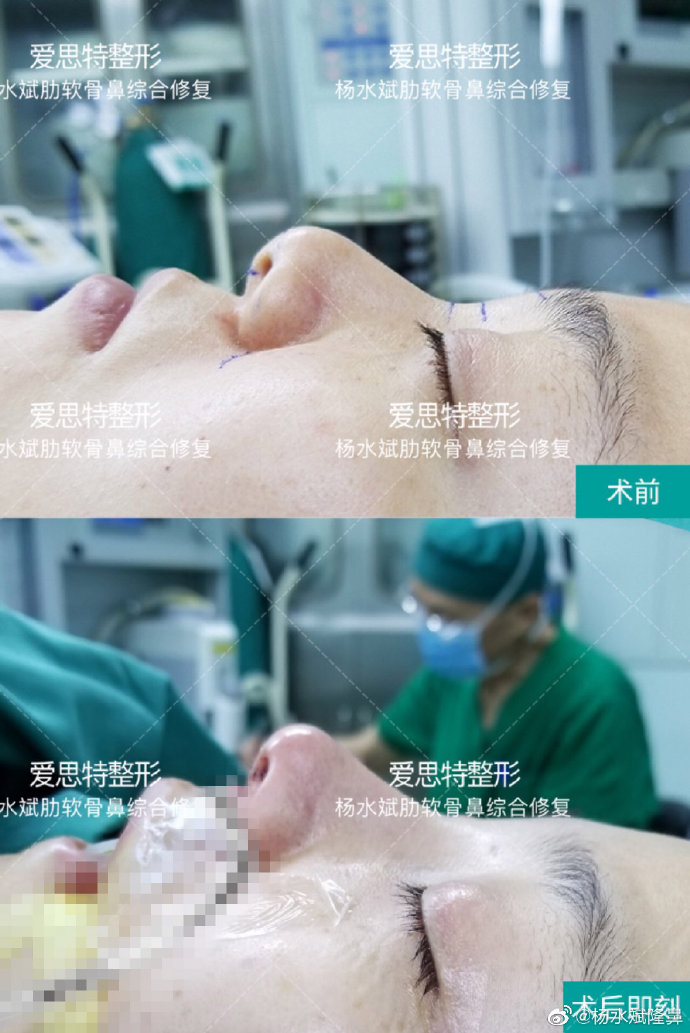 楊水斌肋軟骨鼻綜合修復案例