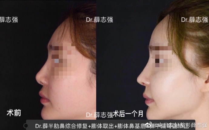 北京權威鼻修復專家都有哪些，大概價格多少？
