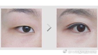 劉珍君雙眼皮案例