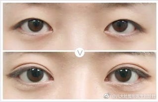 劉珍君雙眼皮案例