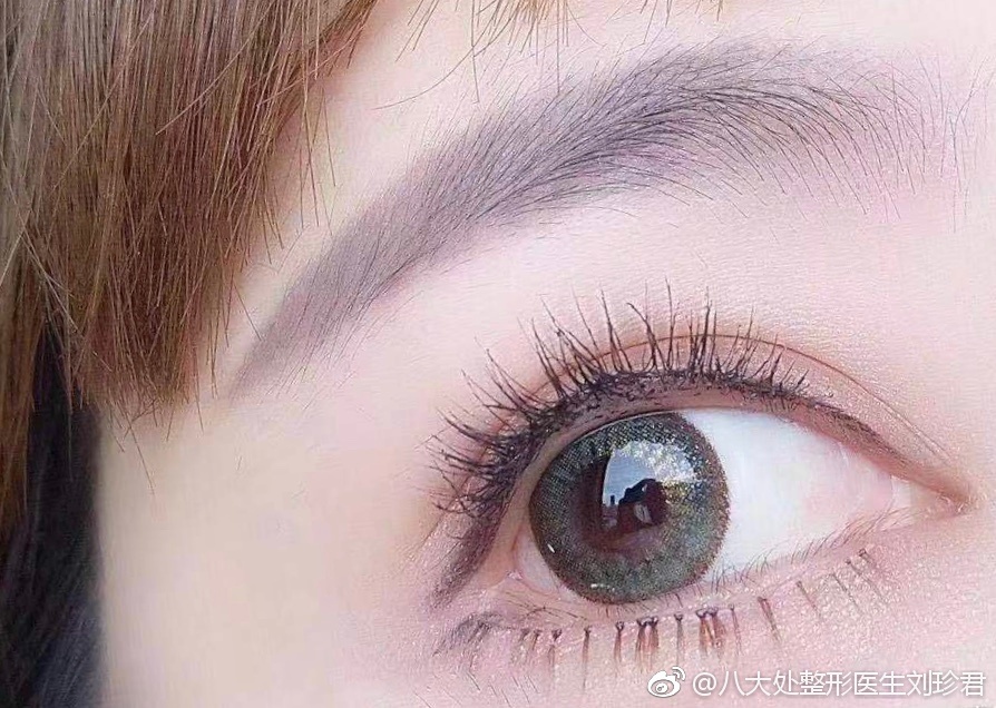 八大處整形醫(yī)院劉珍君做雙眼皮好不好?
