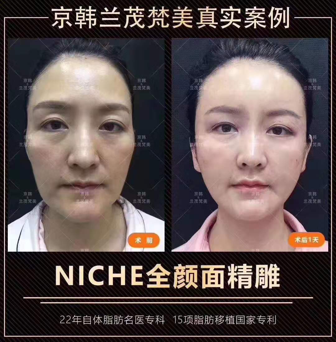 喬愛軍面部精雕案例