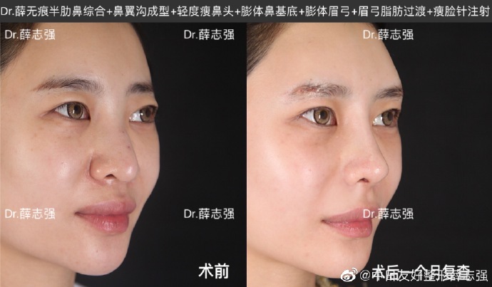 薛志強鼻修復案例