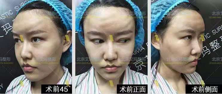 韋元強面部脂肪修復案例