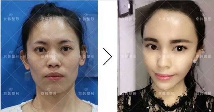 喬愛(ài)軍面部精雕案例