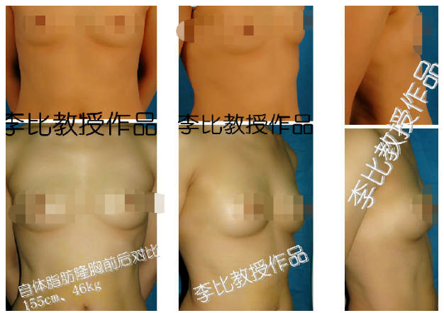 李比自體脂肪豐胸案例