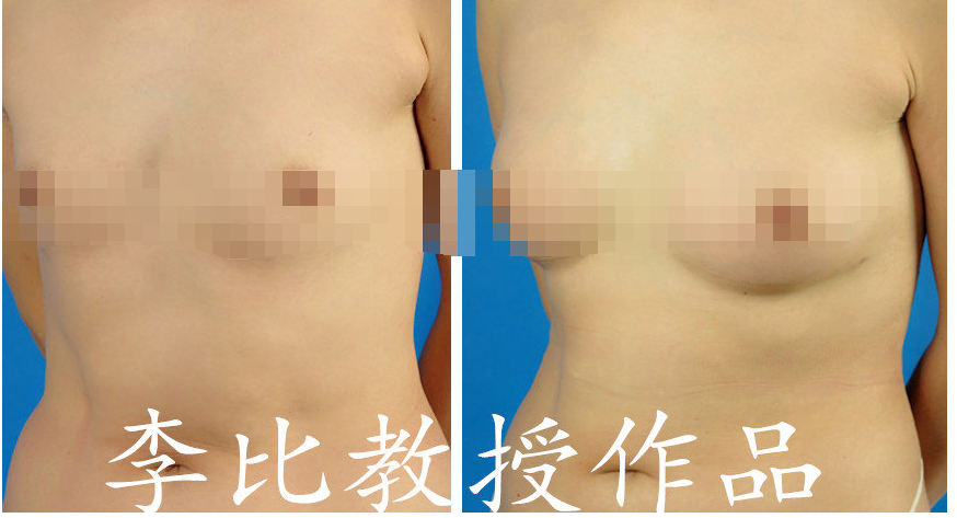 李比自體脂肪豐胸案例