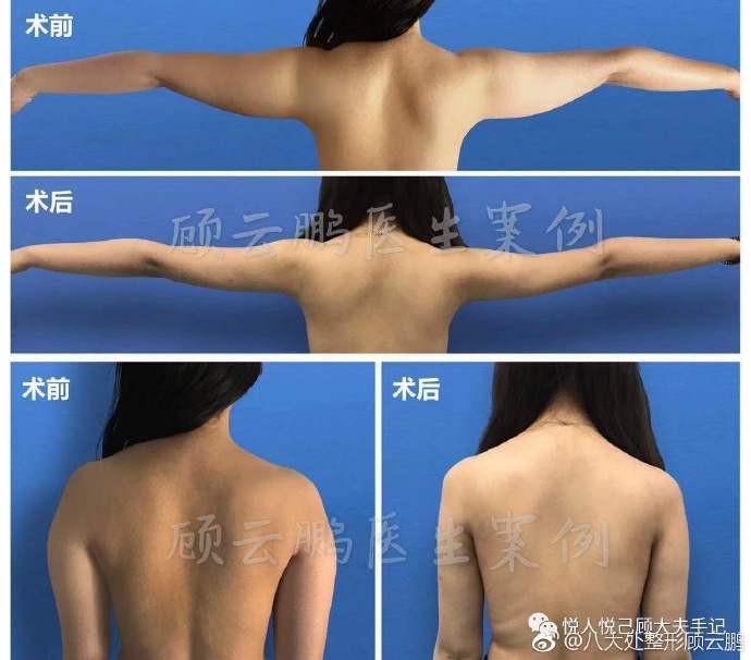 顧云鵬吸脂案例