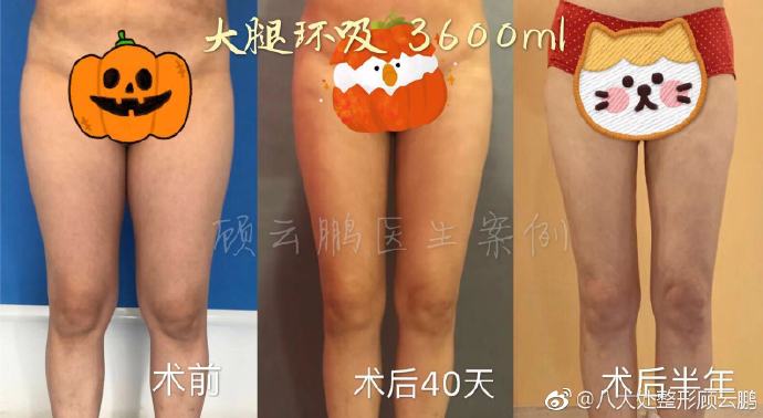 顧云鵬吸脂案例
