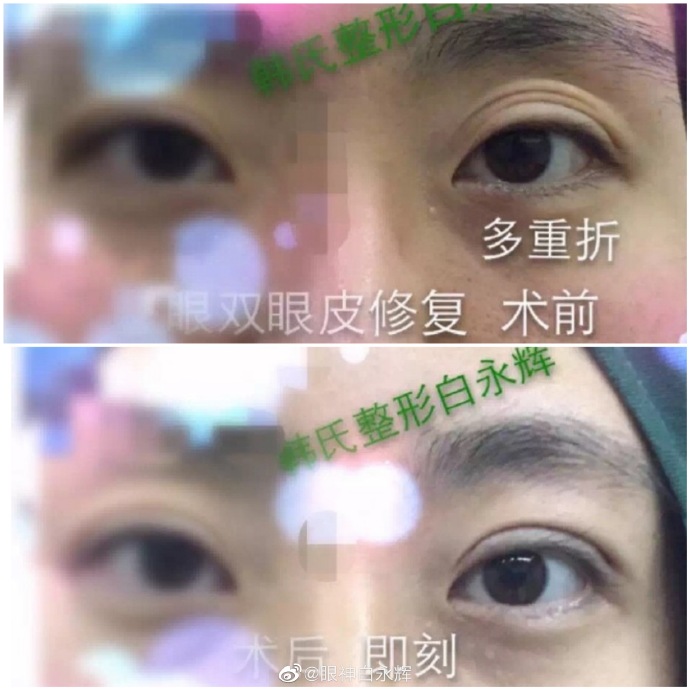 白永輝雙眼皮修復(fù)案例