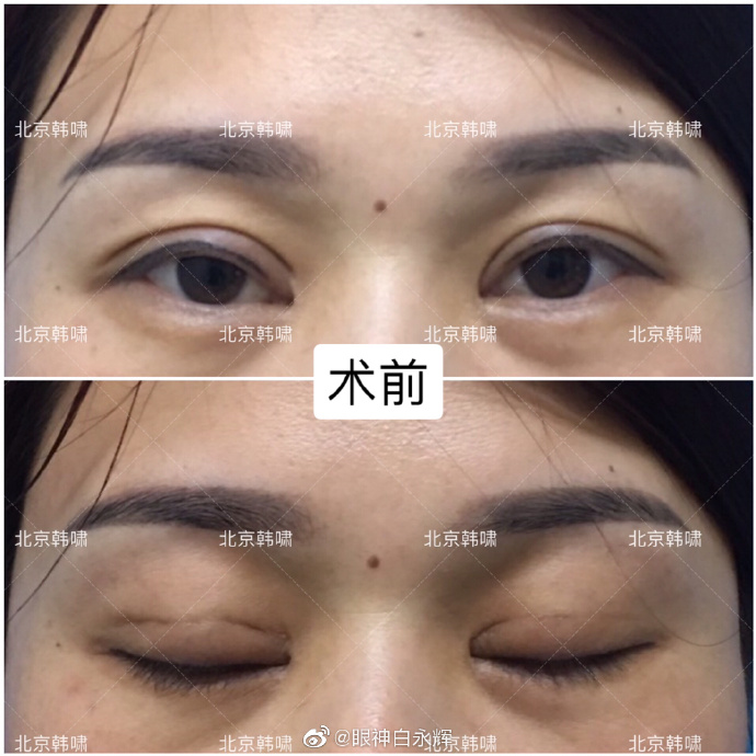 白永輝雙眼皮修復(fù)案例