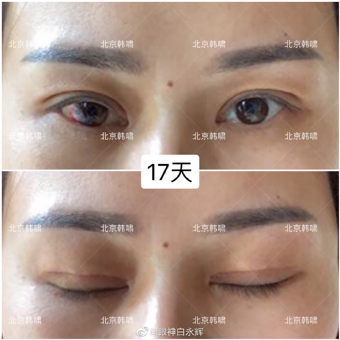 白永輝雙眼皮修復(fù)案例