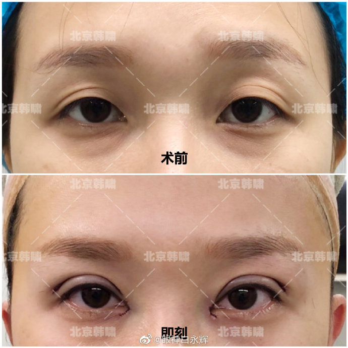 白永輝雙眼皮修復(fù)案例