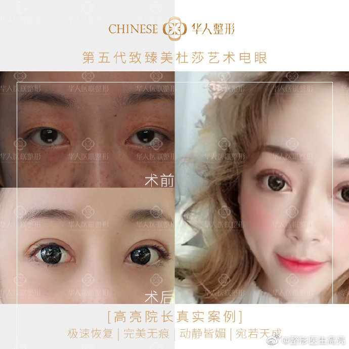 高亮雙眼皮修復(fù)案例