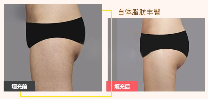 孫瑞霞自體脂肪豐臀案例