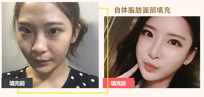 孫瑞霞面部脂肪填充案例