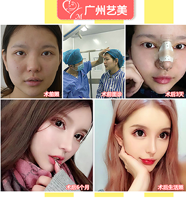 李闖隆鼻案例