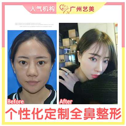 李闖隆鼻案例