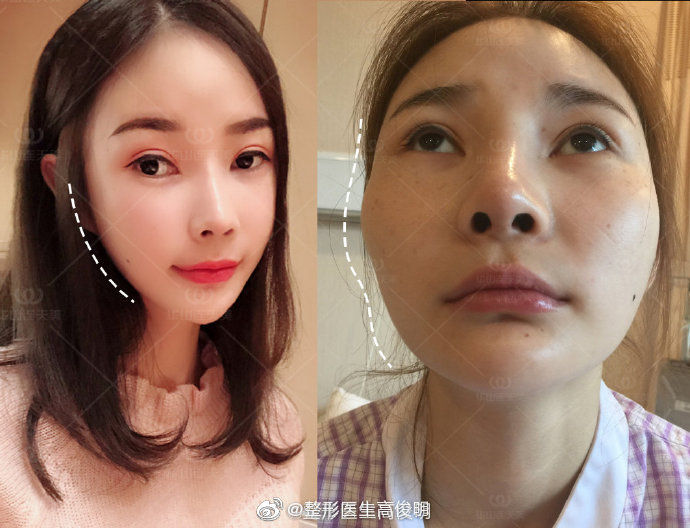 高俊明改臉型案例