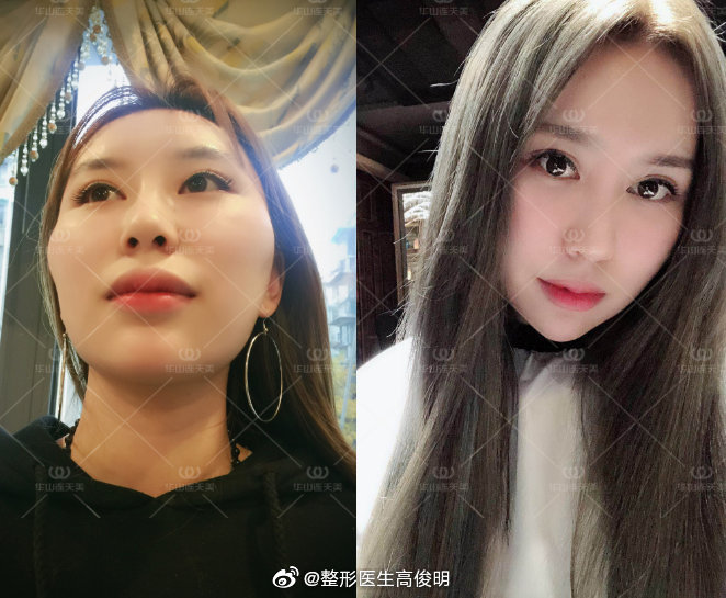 高俊明改臉型案例