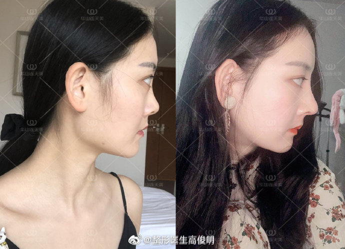 高俊明改臉型案例
