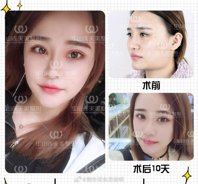 高俊明改臉型案例