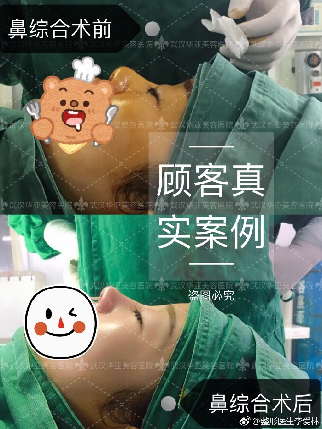 李愛林鼻綜合案例