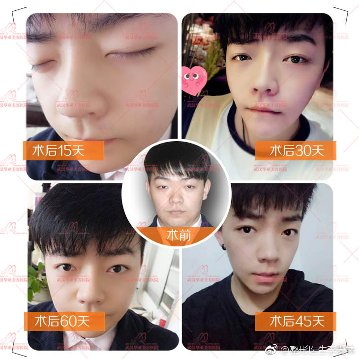 李愛林隆鼻案例