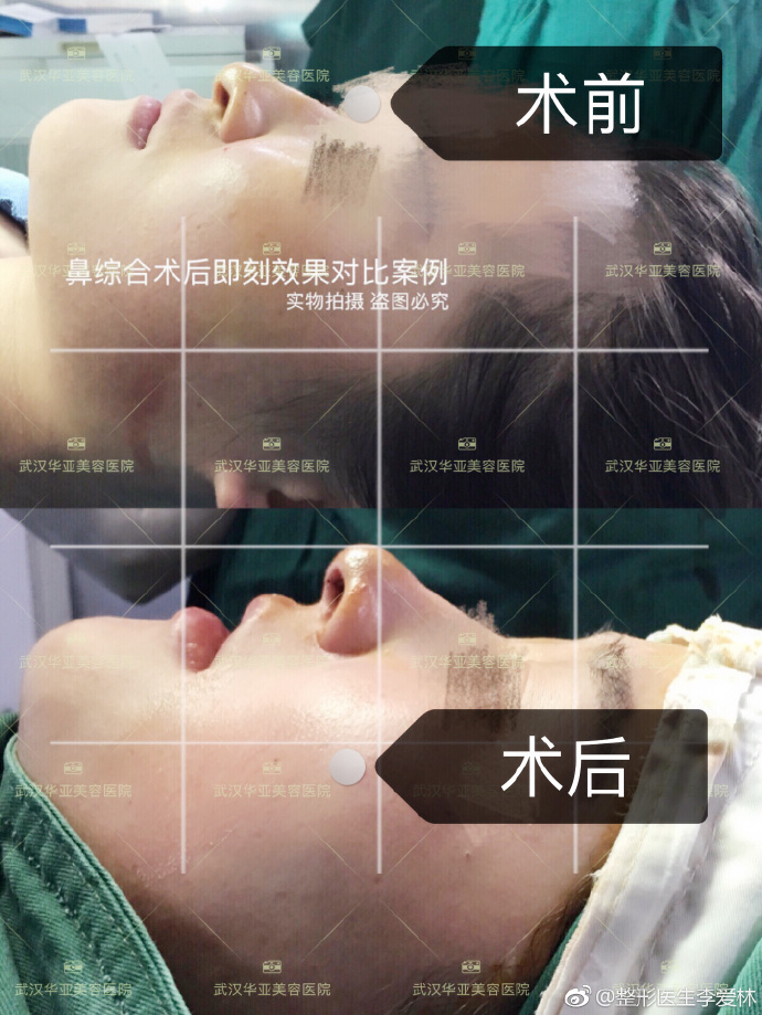 李愛林隆鼻案例